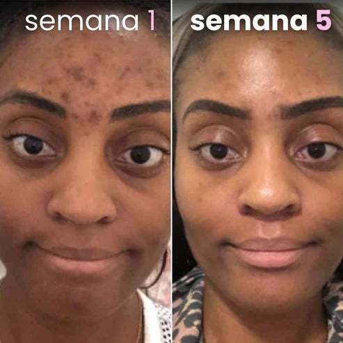 Alemi® - Limpiadores de ácido kójico y cúrcuma